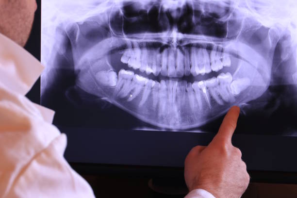 Best Knocked-Out Tooth (Avulsed Tooth) Treatment in Mastic, NY